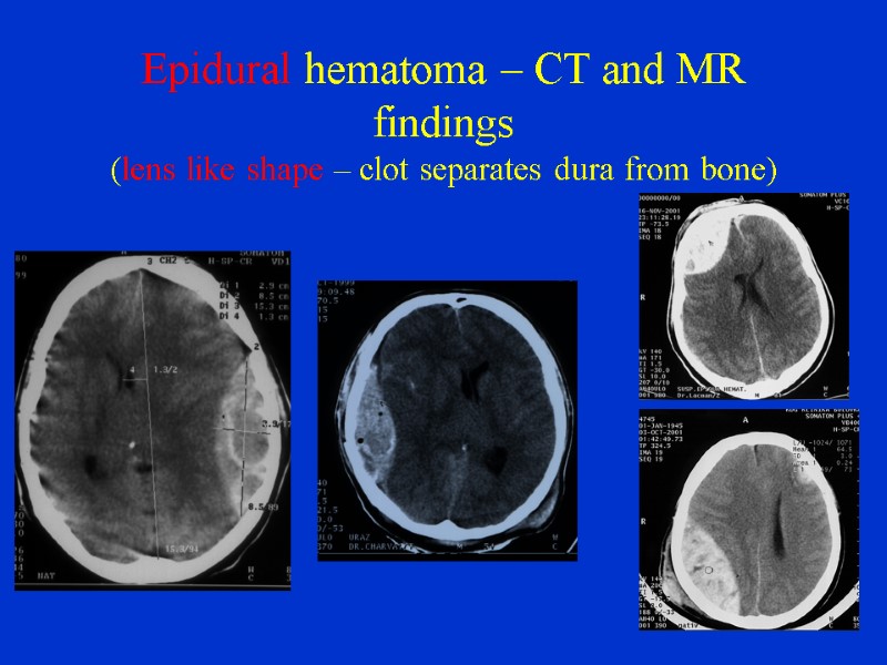 Epidural hematoma – CT and MR findings (lens like shape – clot separates dura